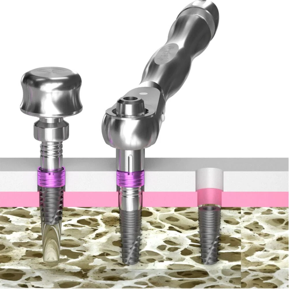 Implant Guide System